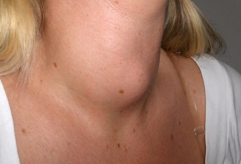 What’s Myxedema and How is it Handled?