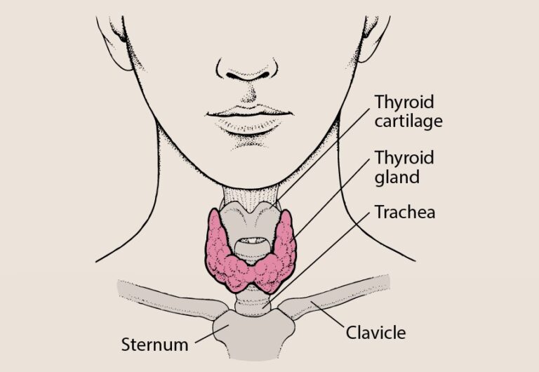What You Need to Know about Goiter