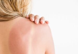 Sunburn Injury to Pores and skin and Prevention Suggestions
