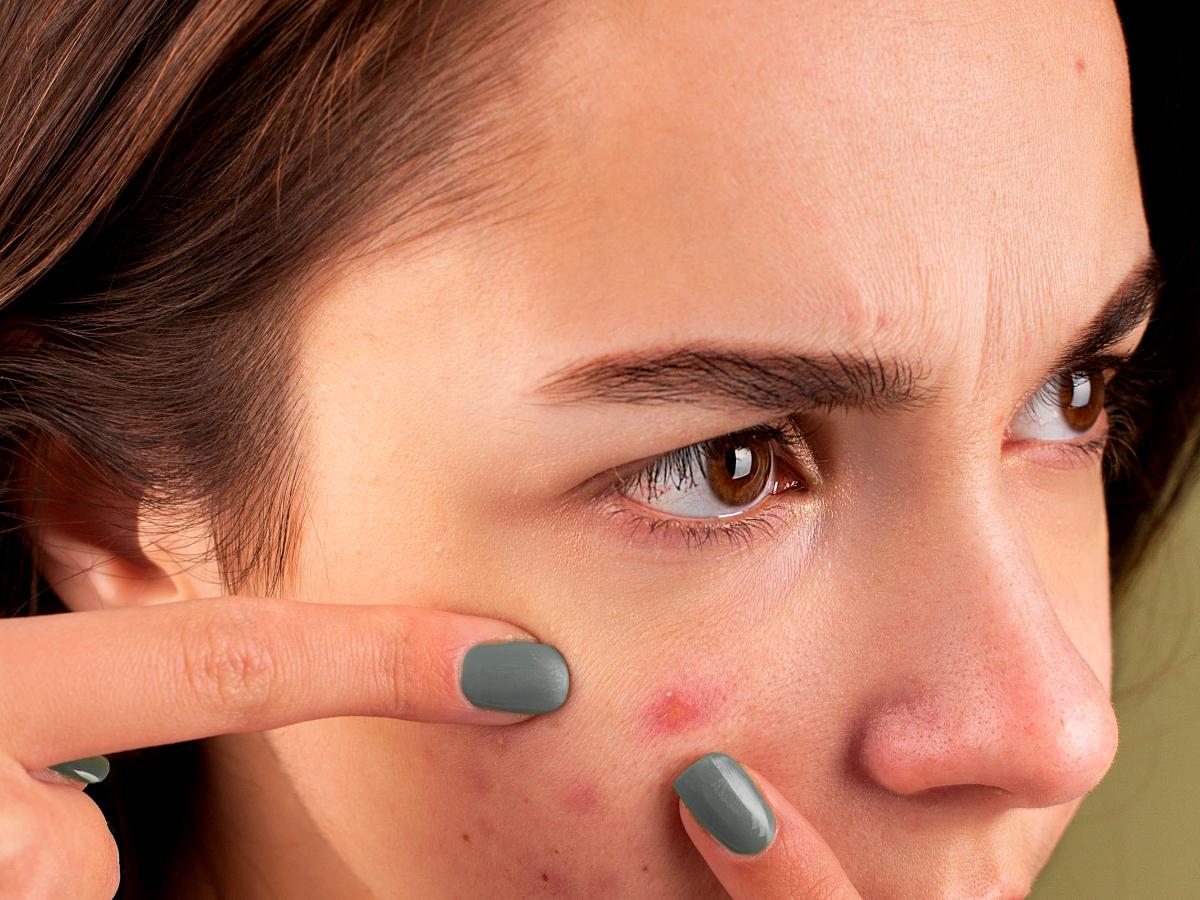 How To Handle A Dreaded Pimple