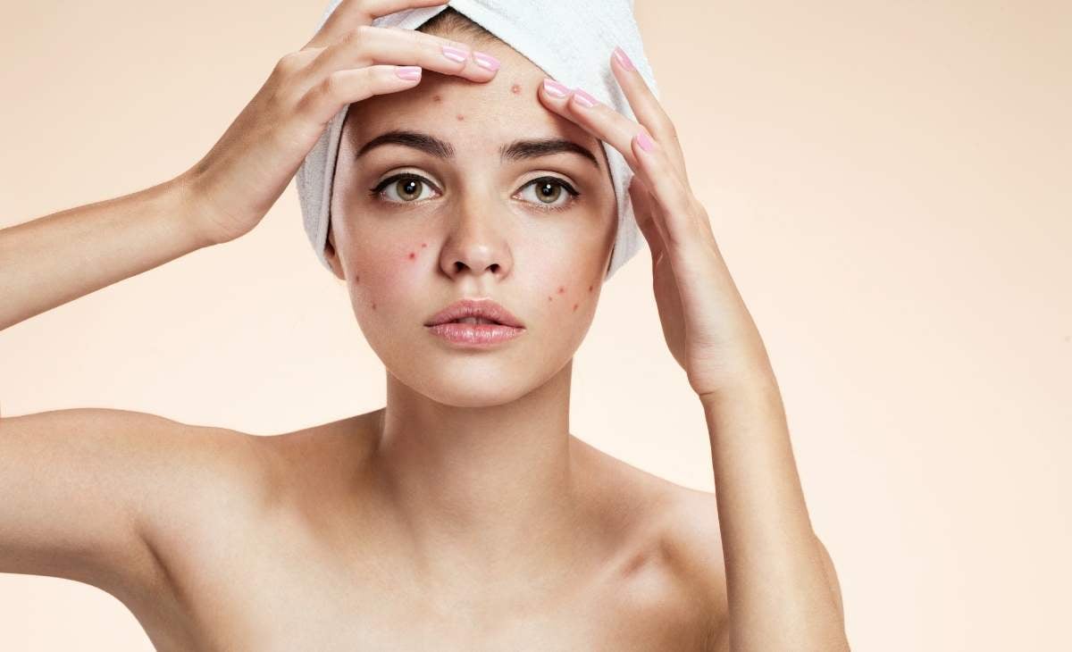 How To Get Rid Of Zits In Simple 4 Steps